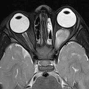 U thần kinh đệm