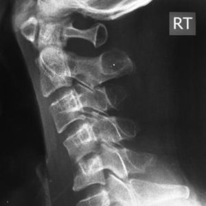 Nhiễm trùng cột sống