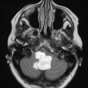 U nang bì nội sọ