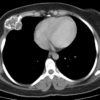 Sarcoma sụn - Hình ảnh 2