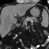 Lymphoma gan - Hình ảnh 3