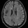 Cavernoma - Hình ảnh 3