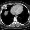 Sarcoma sụn - Hình ảnh 3