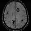 Cavernoma - Hình ảnh 4