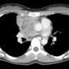 Lymphoma trung thất - Hình ảnh 4