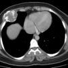 Sarcoma sụn - Hình ảnh 4