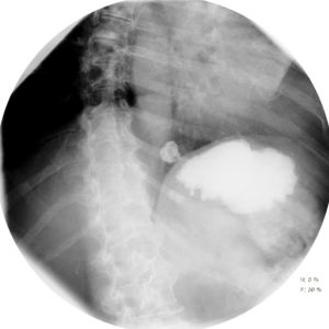 Túi thừa dạ dày