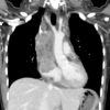 Lymphoma trung thất - Hình ảnh 5