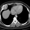 Sarcoma sụn - Hình ảnh 5