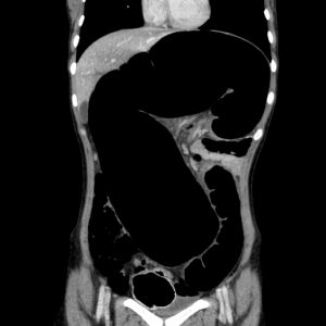 Xoắn đại tràng Sigma