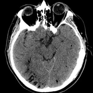 Thuyên tắc khí não
