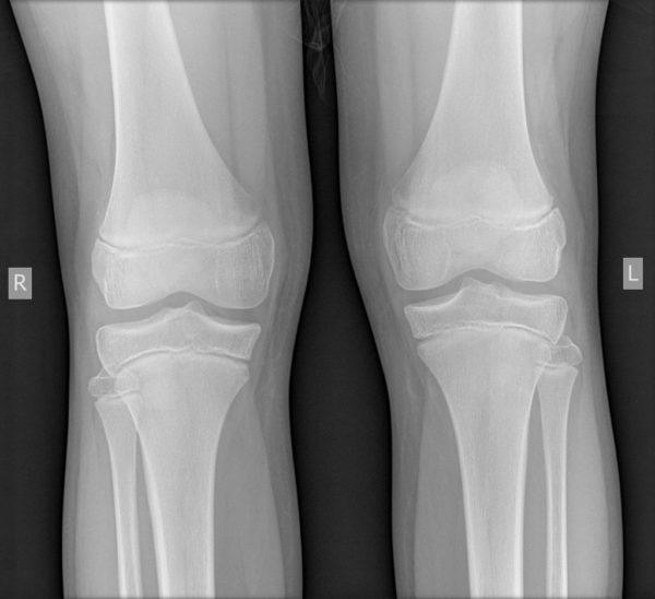 Osgood Schlatter