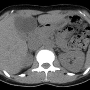 U tuyến đường mật