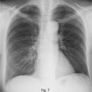 Nang lách vôi hóa