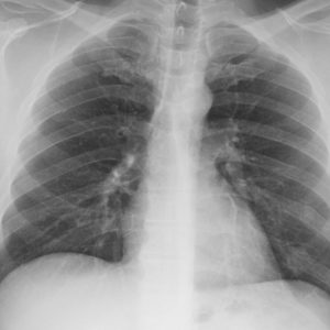 Gãy xương sườn