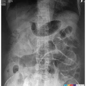 Khí tự do ổ bụng