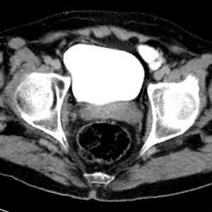 Thoát vị thành bụng