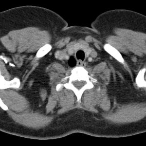 Túi thừa khí quản