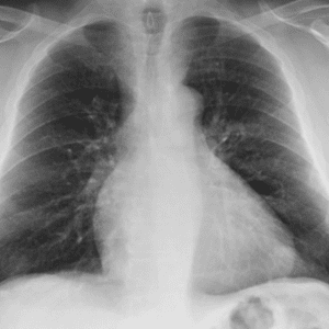 Hamartoma phổi