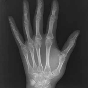Gãy xương bàn tay