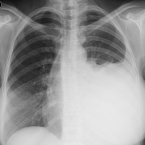 Lymphoma