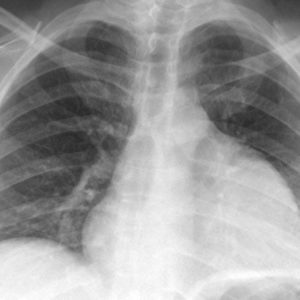 Sarcoma trung thất