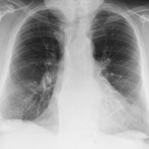 Thoái hóa xương khớp