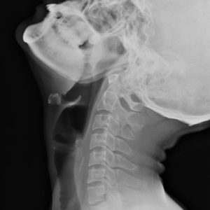 Dị vật ống tiêu hóa