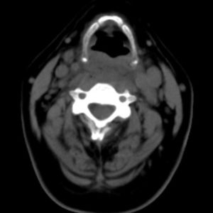 Dị vật ống tiêu hóa