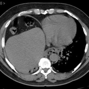 Dị vật ống tiêu hóa