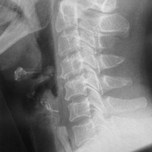 Dị vật ống tiêu hóa