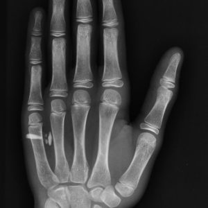 Dị vật phần mềm