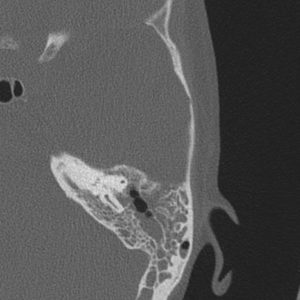 Viêm tai xương chũm