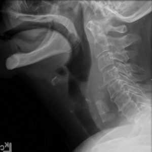 Dị vật ống tiêu hóa