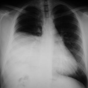 Chấn thương cơ hoành