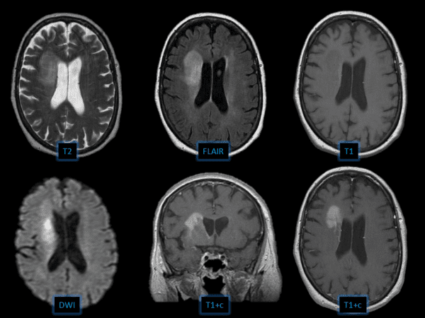 Lymphoma não