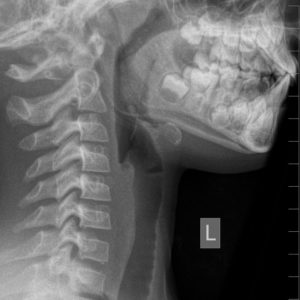 Dị vật ống tiêu hóa