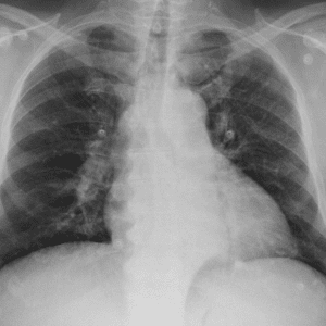 Giãn TM trung thất