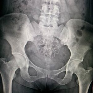 Dị vật ổ bụng