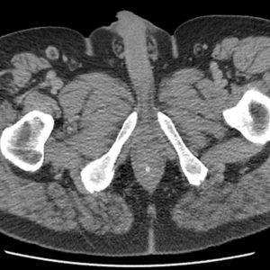 Dị vật ống tiêu hóa