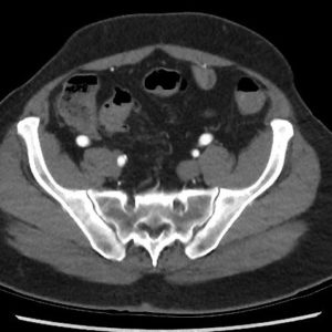 Chảy máu đại tràng