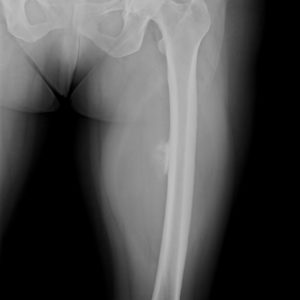 U mỡ màng xương