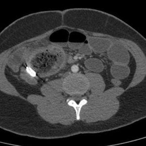 Dị vật ổ bụng