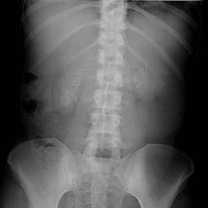 Dị vật ổ bụng