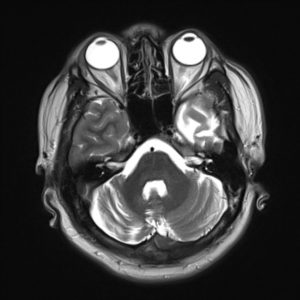 Teo thùy thái dương