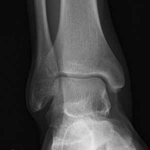 Gãy mắt cá trong