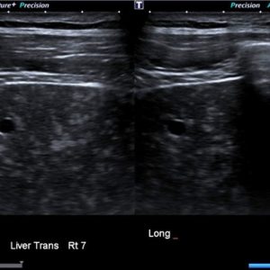 Hamartoma đường mật