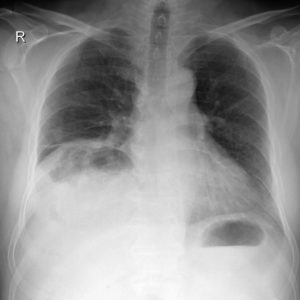 Hội chứng Chilaiditi