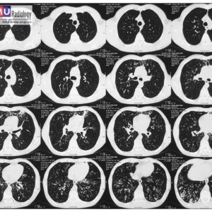 Giãn động mạch phế quản