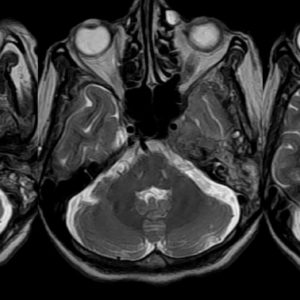 Viêm tai xương chũm